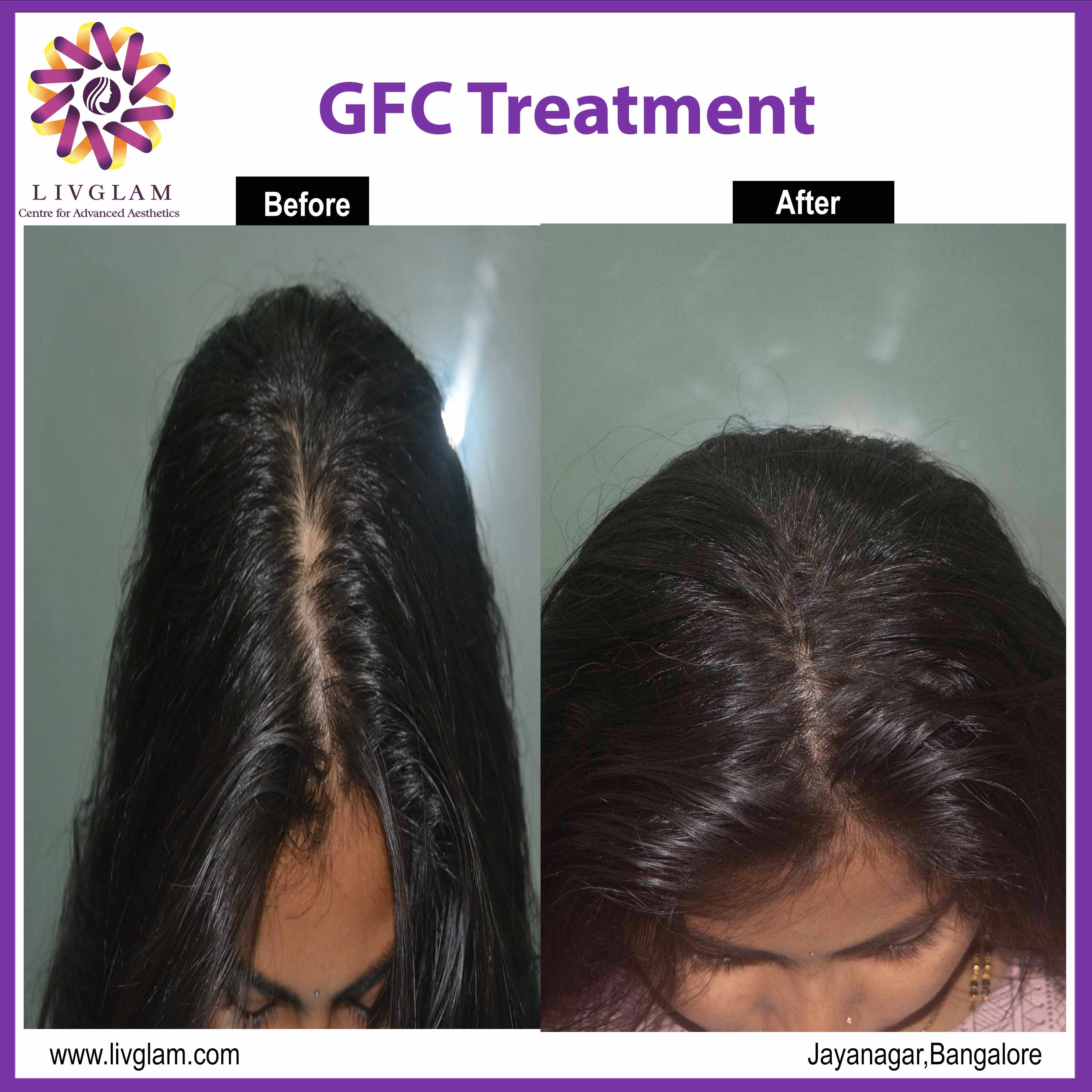 Hair Grafting Cost in Bangalore | Hair Transplantation in Bangalore