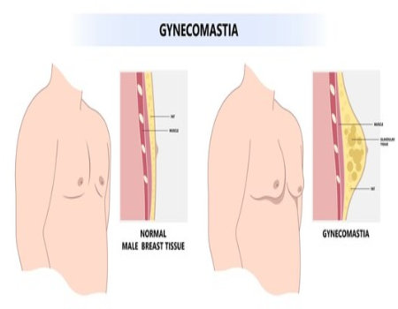 male breast reduction surgery