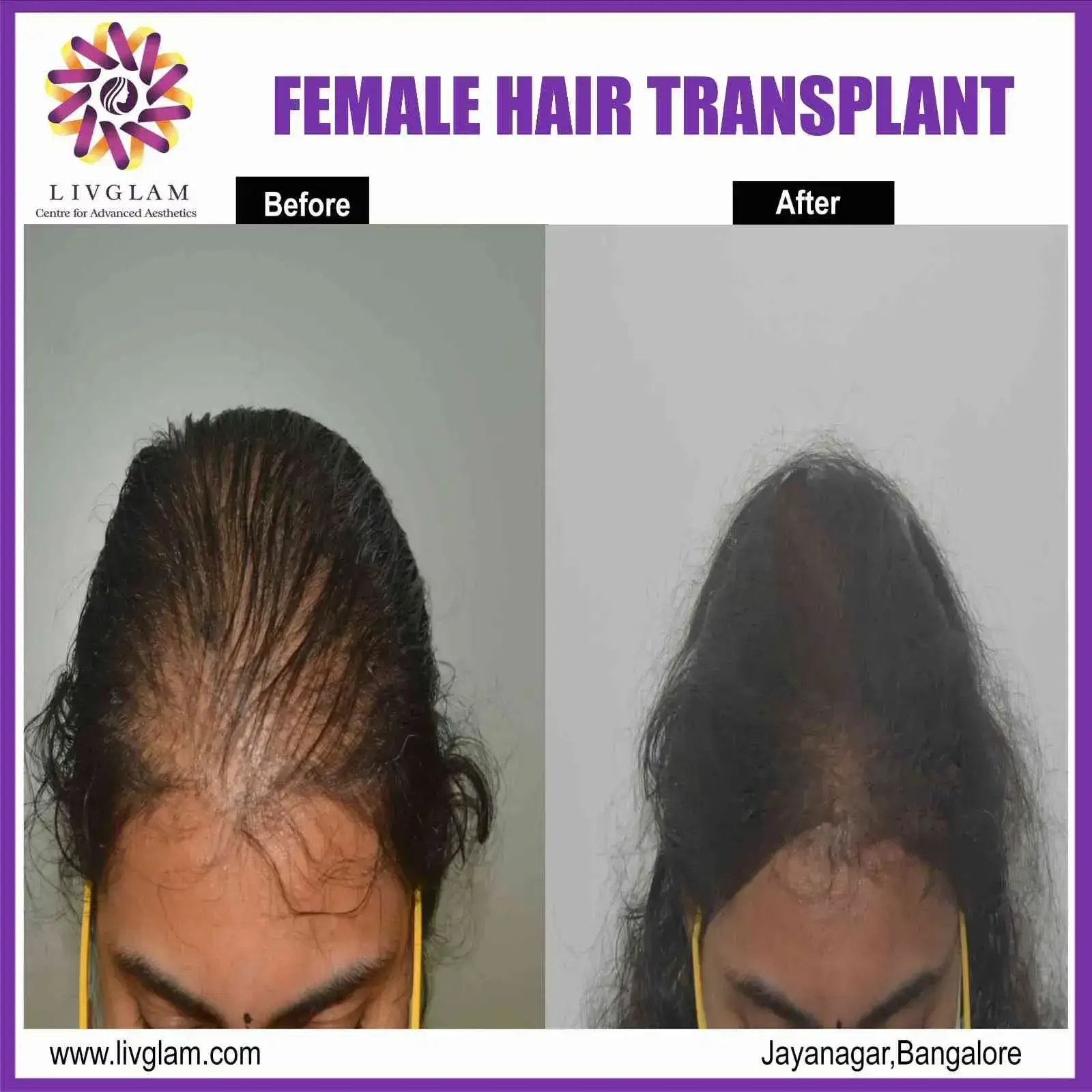 female hair transplant in bangalore