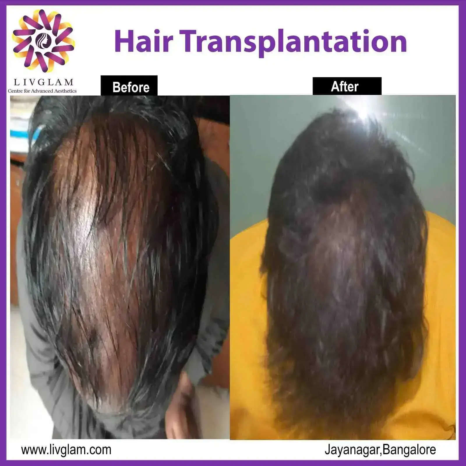 GFC treatment in bangalore