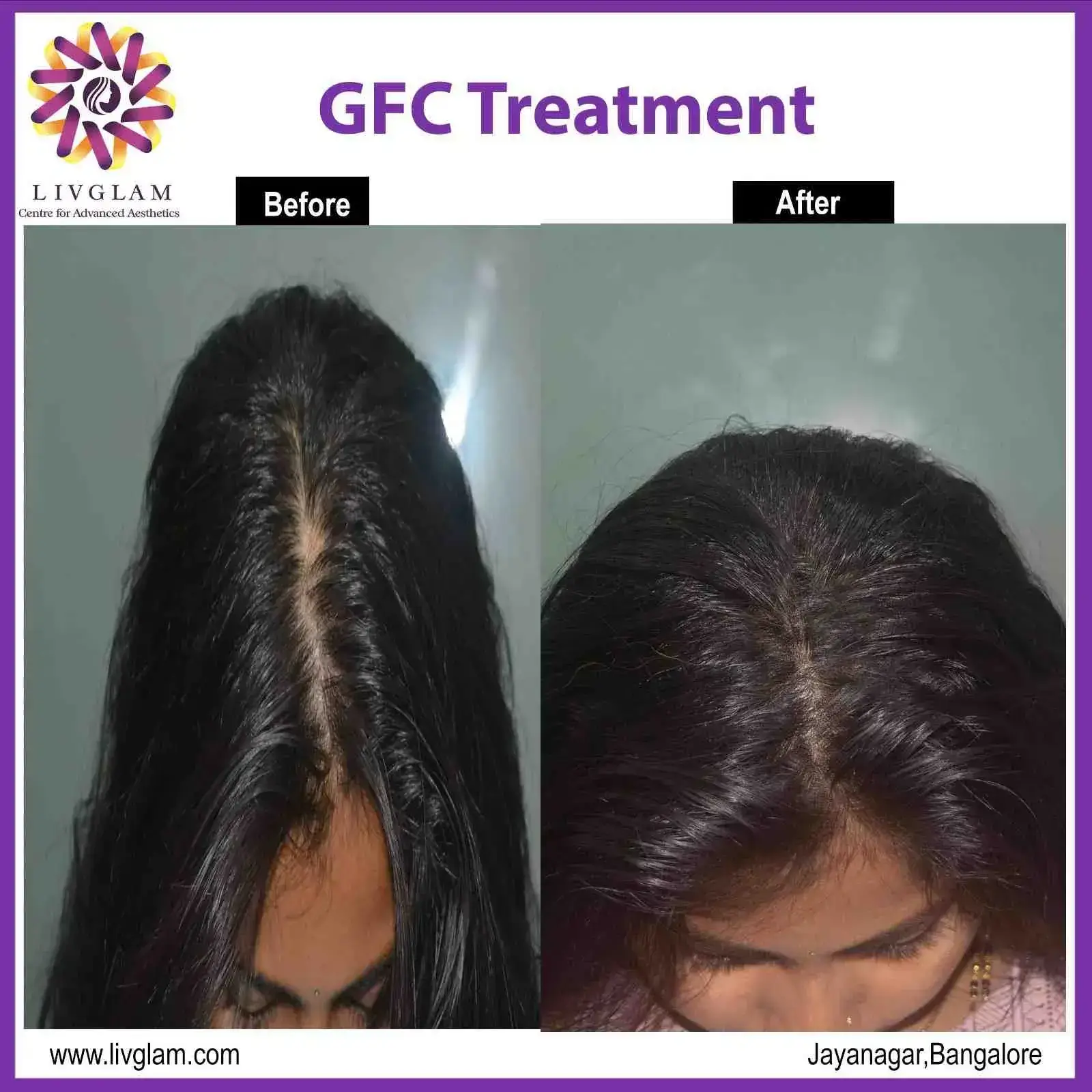 Best GFC treatment in bangalore