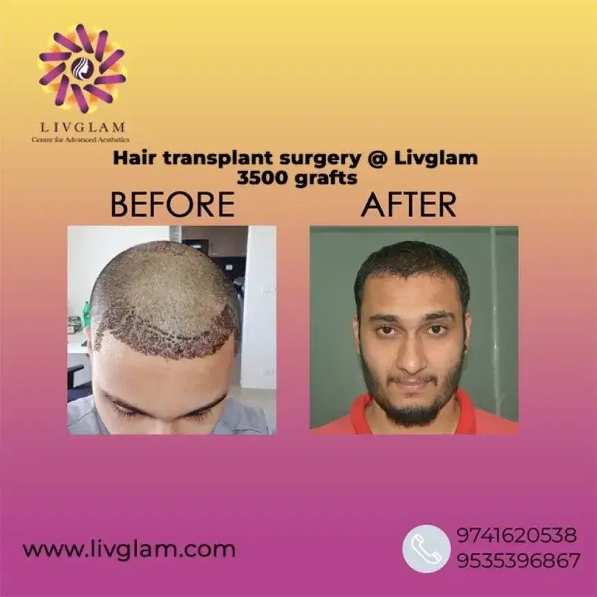 hair transplant in bangalore