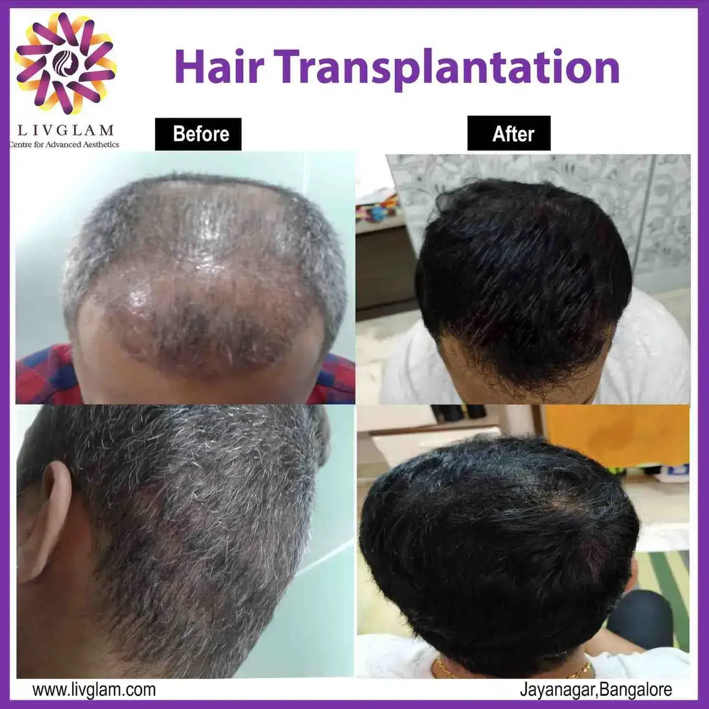 hair transplant clinic in bangalore