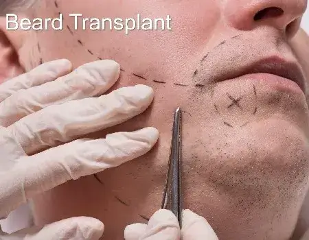 Beard transplant in bangalore