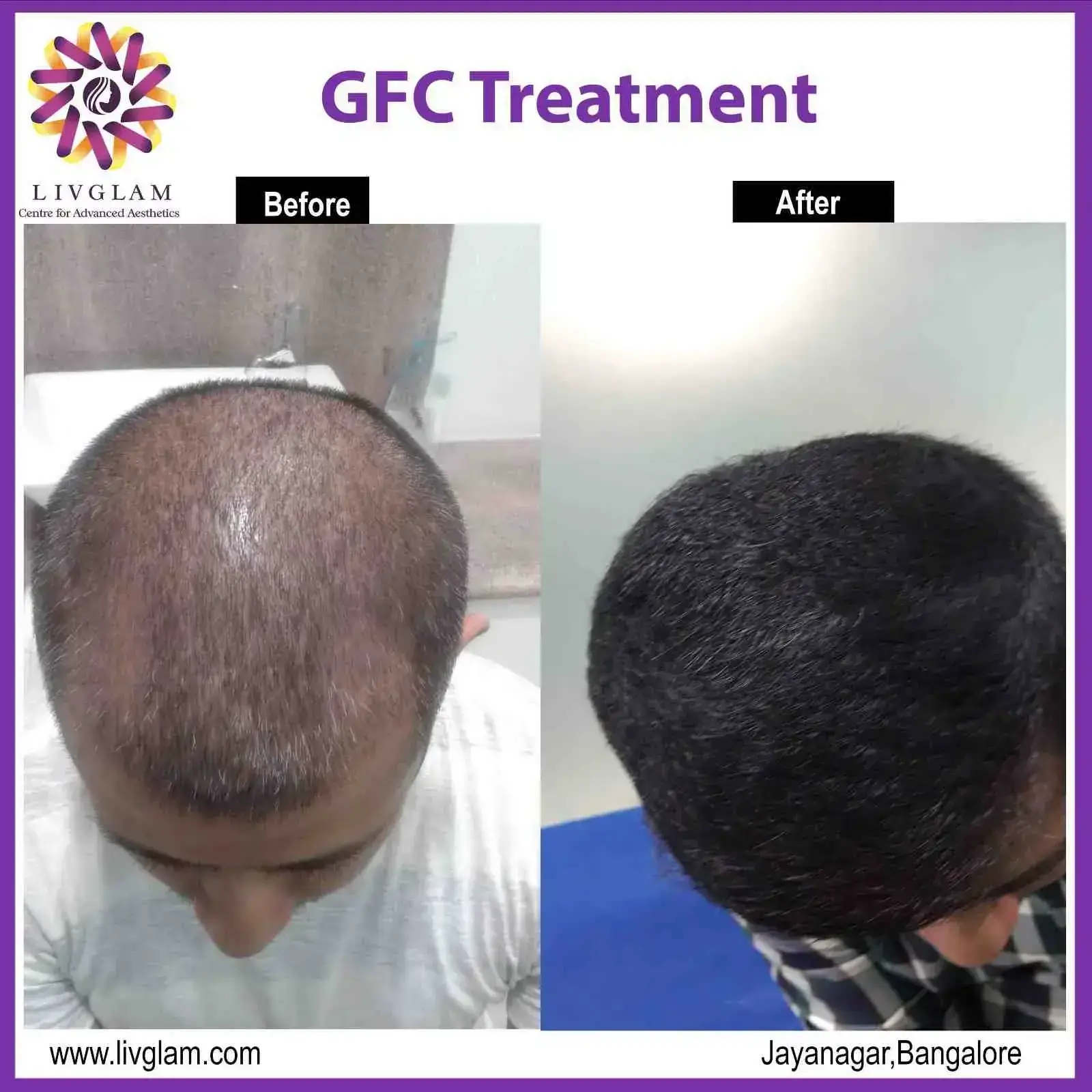 hair grafting in bangalore