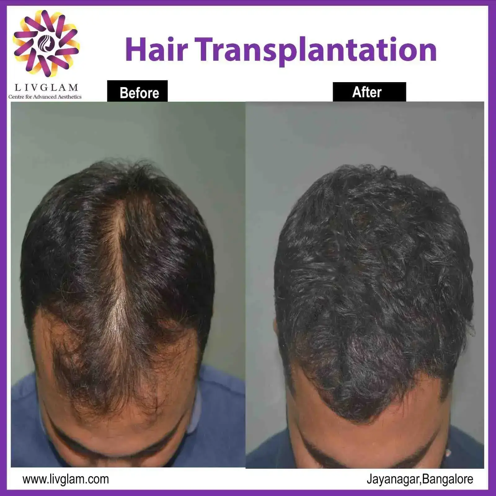 hair transplantation in bangalore