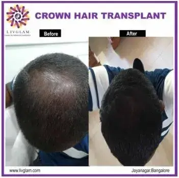 crown hair transplant in bangalore