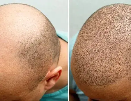 hair transplant cost in bangalore