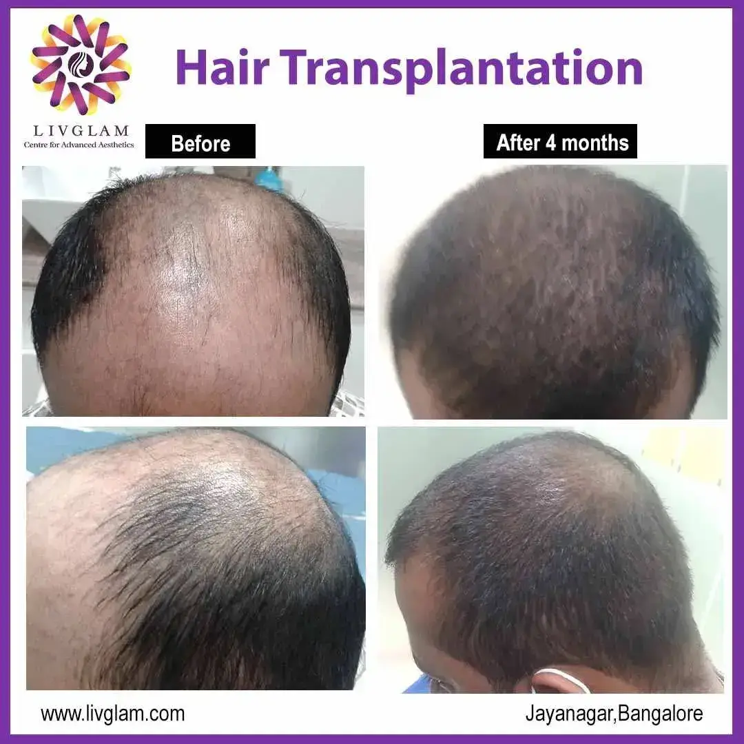 Best hair transplant in bangalore