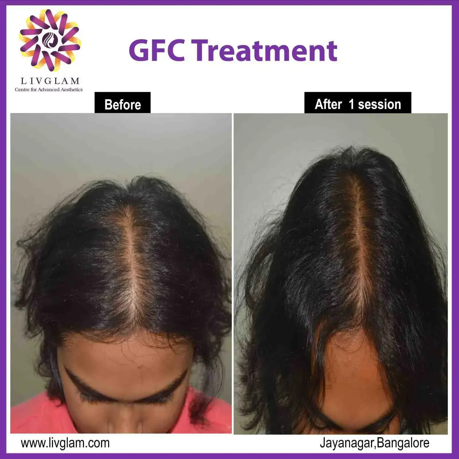 hair transplant cost in bangalore