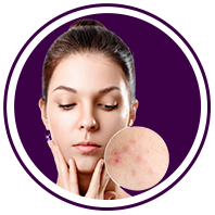 acne removal services